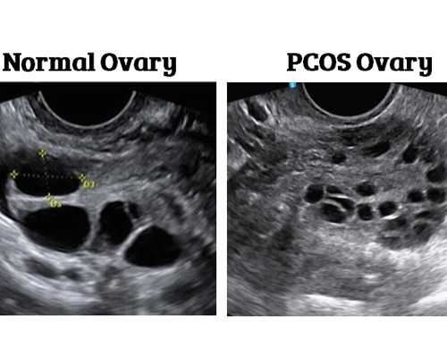 代生技术，注射尿素促卵泡素做试管
